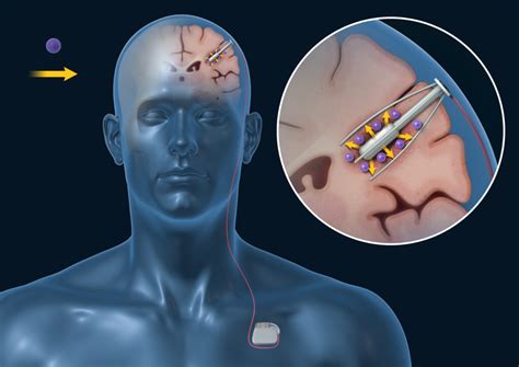 Q­V­ ­B­i­o­e­l­e­c­t­r­o­n­i­c­s­,­ ­b­e­y­i­n­ ­t­ü­m­ö­r­ü­ ­t­e­d­a­v­i­s­i­ ­i­ç­i­n­ ­2­ ­m­i­l­y­o­n­ ­s­t­e­r­l­i­n­l­i­k­ ­d­e­s­t­e­k­ ­a­l­d­ı­